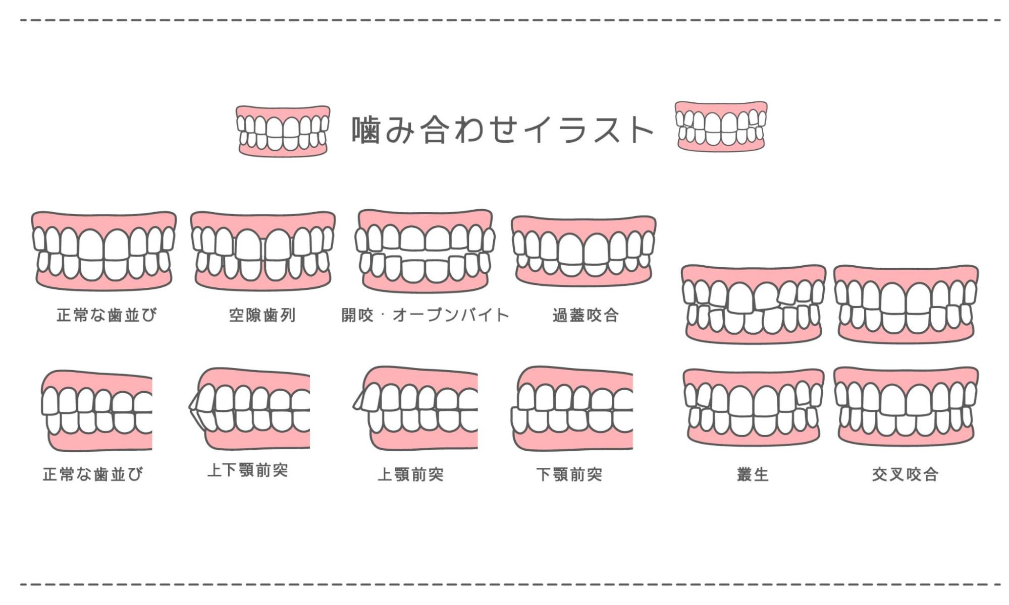 噛み合わせが悪いとどうなる？ 理想の噛み合わせと悪い噛み合わせ