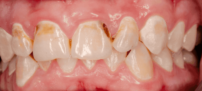 虫歯の放置