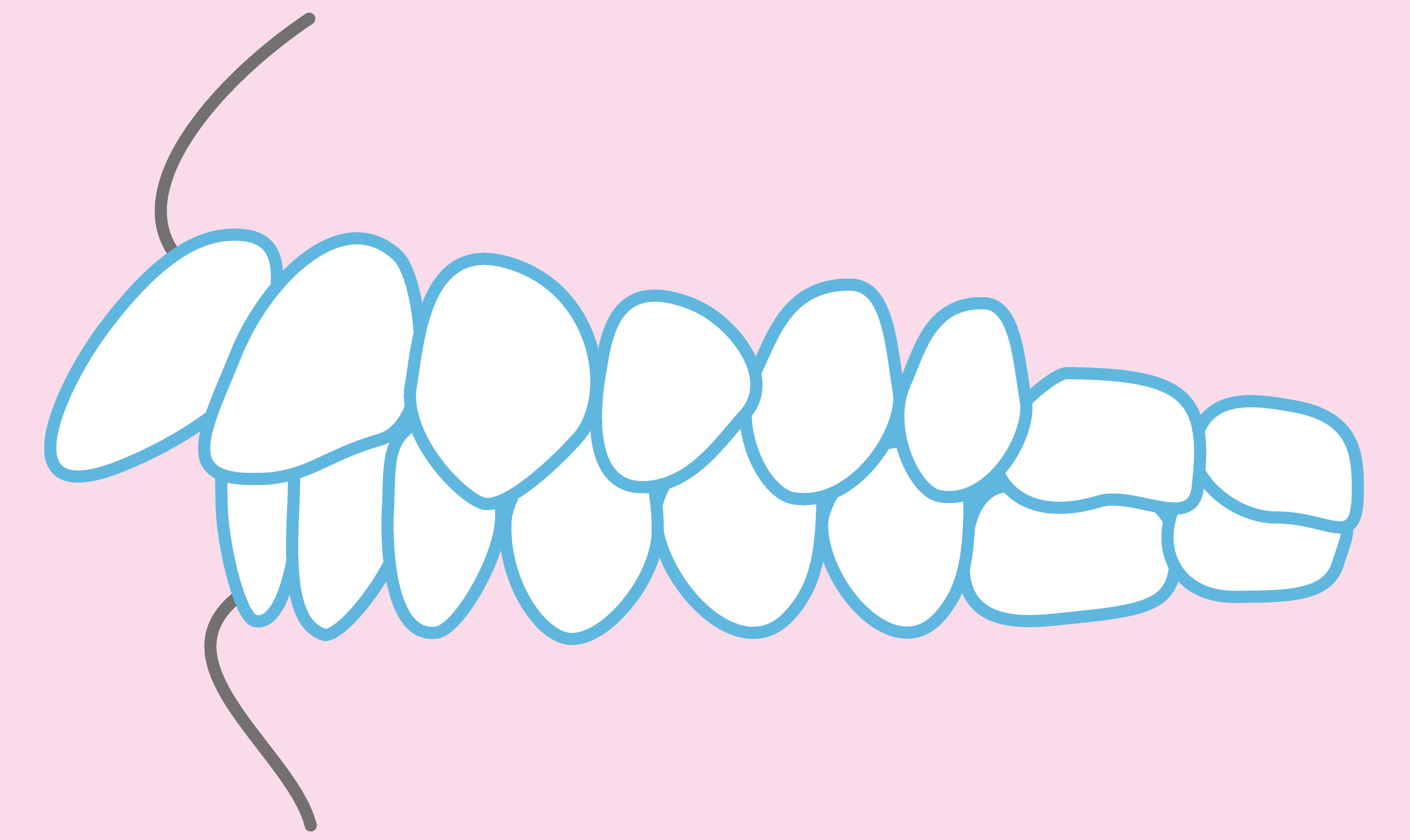 出っ歯の原因は遺伝だけじゃない！ 大人の出っ歯は自力で防げたり治したりできる？