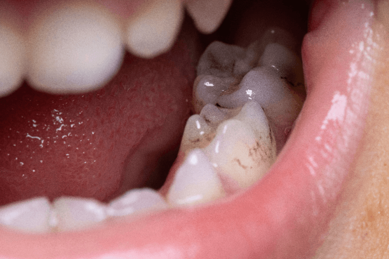 マウスピース矯正　虫歯