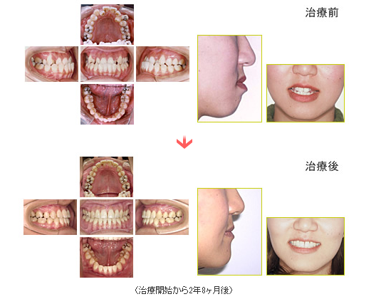 下顎前突（受け口）をマルチブラケットとMFTで治療した症例