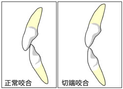 切端咬合とは