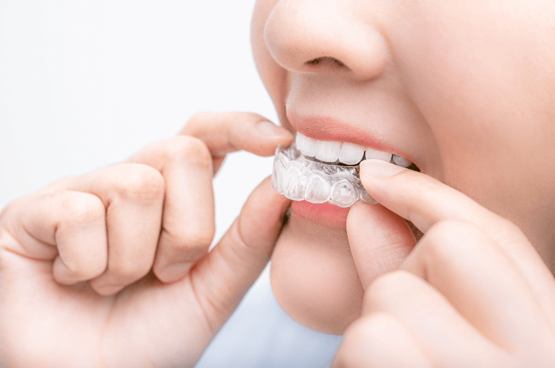 歯列矯正中　ホワイトニング