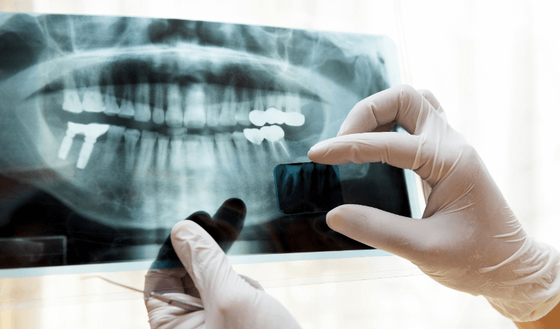 歯周病 予防 治療
