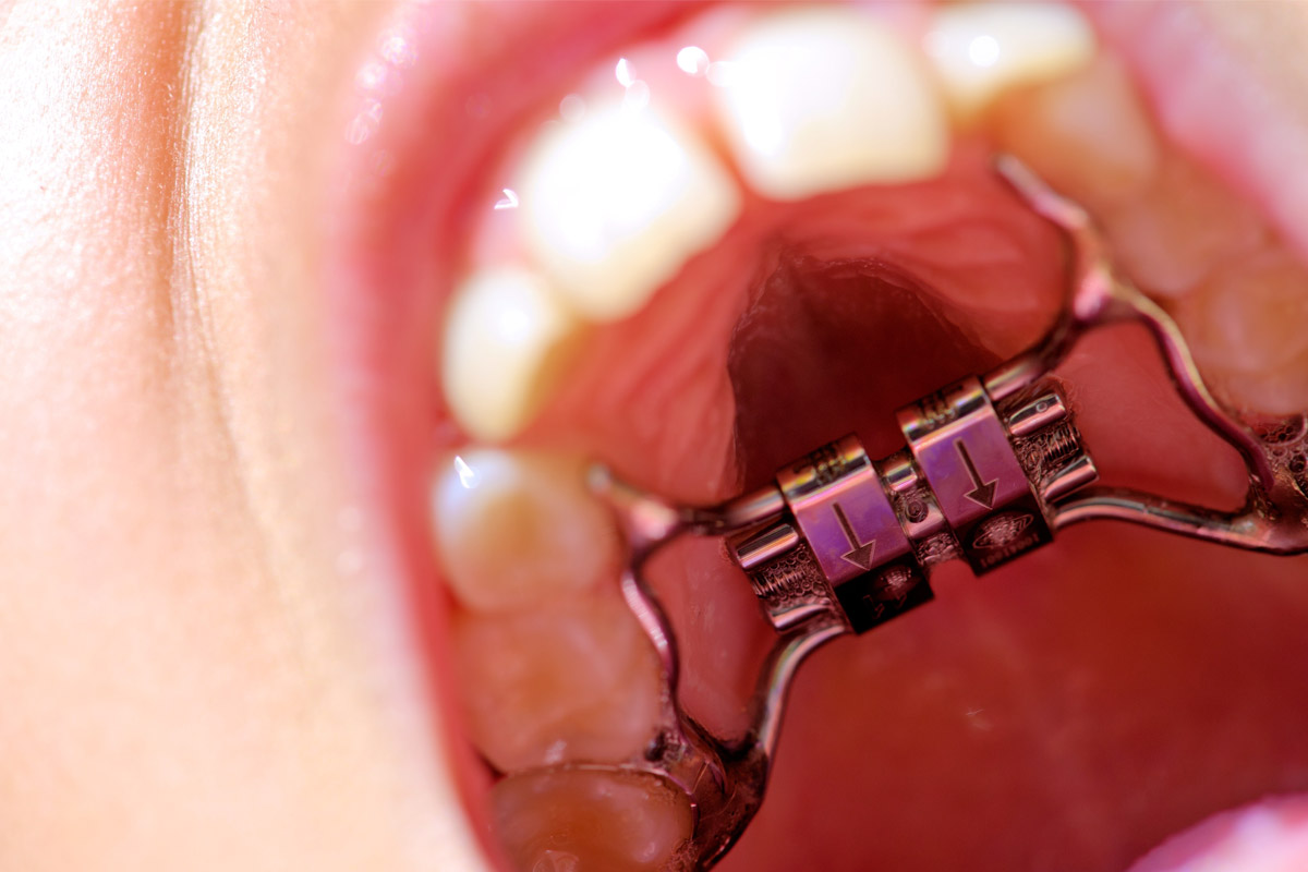 拡大 装置 上顎 上顎拡大装置に対処する 4つの方法