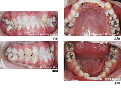 マウスピース　反対咬合　矯正