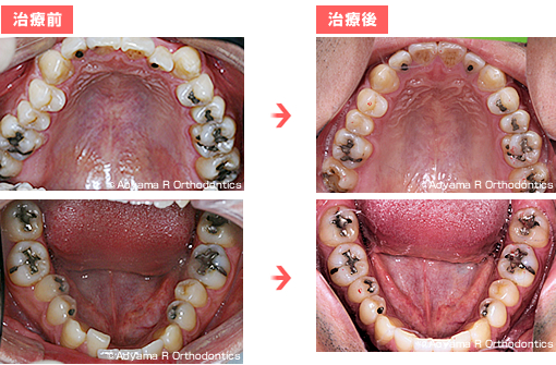 AFTER　治療前後の比較 (上顎・下顎)