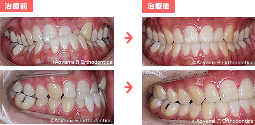 AFTER　治療前後の比較 (正面・側方)