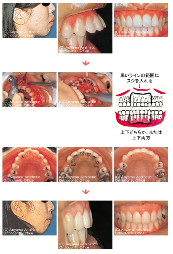 コルチコトミー（促進矯正法）を併用した症例