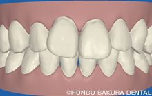 3Dシミュレーション画像治療前