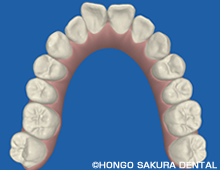 上顎の3D画像治療前