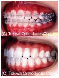 永久歯治療(二期治療)を開始