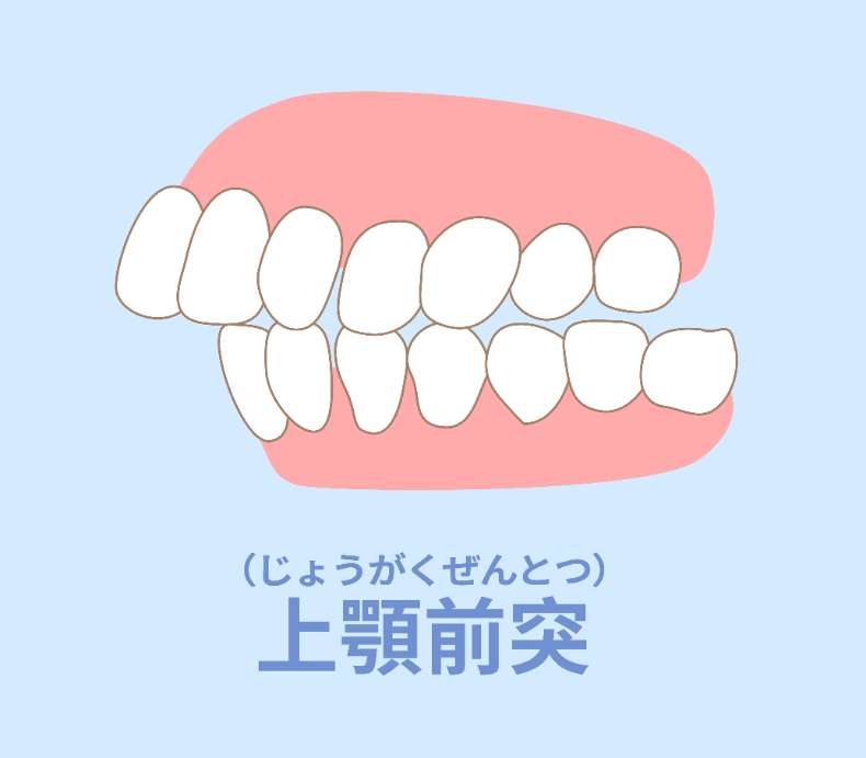 上顎前突