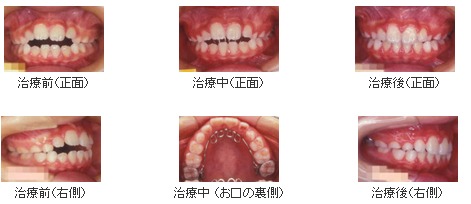 治療前後の写真 （左から治療前、治療中、治療後）