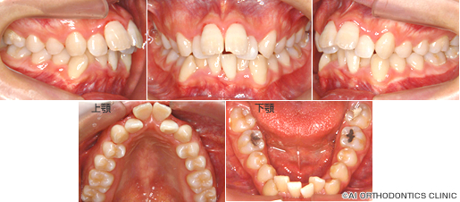 出っ歯と叢生を裏側矯正で治療するため、遠方からの通院された患者様