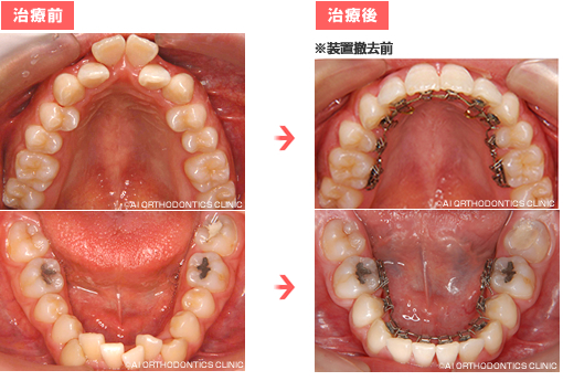 治療前後の比較 (口蓋・舌側)
