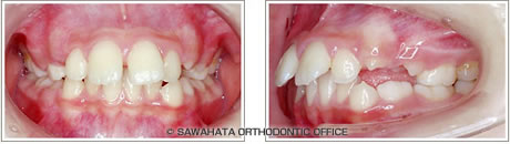 【出っ歯の症例1】 小児矯正の治療例治療前