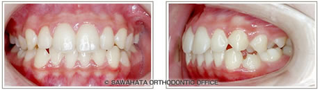 【出っ歯の症例1】 小児矯正の治療例治療後