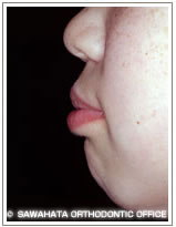 【出っ歯の症例1】 小児矯正の治療例　横顔治療前
