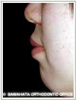 【出っ歯の症例1】 小児矯正の治療例　横顔治療後