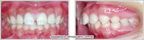  【出っ歯の症例2】 成人矯正の治療例治療前