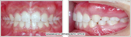 【出っ歯の症例2】 成人矯正の治療例治療後