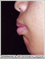  【出っ歯の症例2】 成人矯正の治療例　横顔治療前