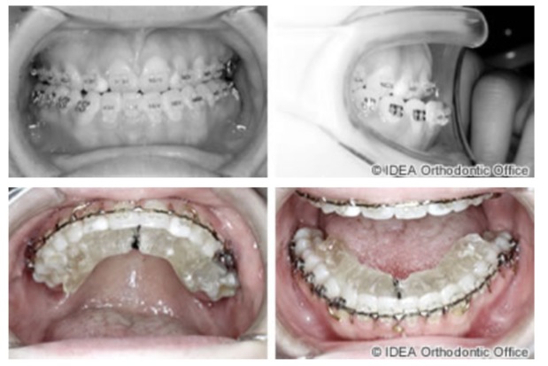 【治療経過】 マルチブラケット装着後のお口の状態　13ヵ月後