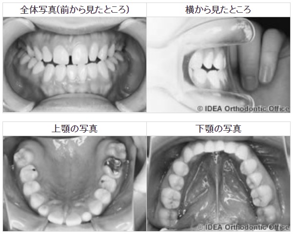 反対咬合を外科矯正で治療した例