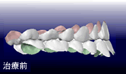 矯正治療分析ソフトによるシミュレーション画像【右横】