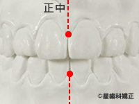 2.上下の正中線（midline［ミッドライン］）が合っている