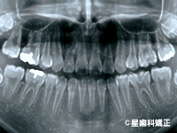 5.歯根が並行（パラレリング）に並んでいるか