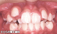 八重歯(乱杭歯）の矯正治療治療前