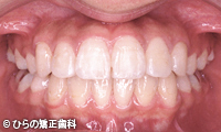 八重歯(乱杭歯）の矯正治療治療後