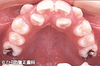 八重歯（乱杭歯）の変遷治療前