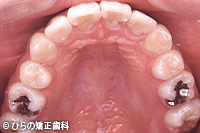 八重歯（乱杭歯）の変遷治療後