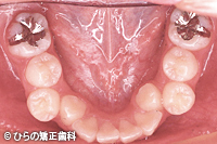 八重歯（乱杭歯）のデメリット治療前
