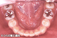 八重歯（乱杭歯）のデメリット治療後