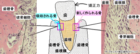 歯に矯正力がかかった時の歯の組織の変化