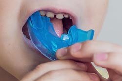 マウスピース型の小児矯正装置