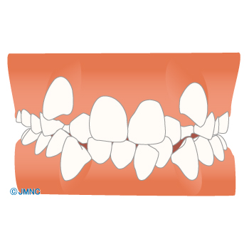 歯並び 不正咬合の無料イラスト素材集 歯科 矯正歯科医院向け 矯正歯科ネット