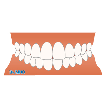 歯並び 不正咬合の無料イラスト素材集 歯科 矯正歯科医院向け 矯正歯科ネット