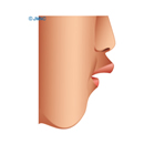 顎変形症（上顎前突症2）