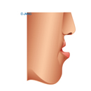 顎変形症（上顎前突症2）