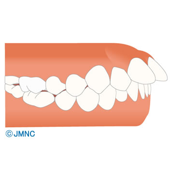 歯並び 不正咬合の無料イラスト素材集 歯科 矯正歯科医院向け 矯正歯科ネット