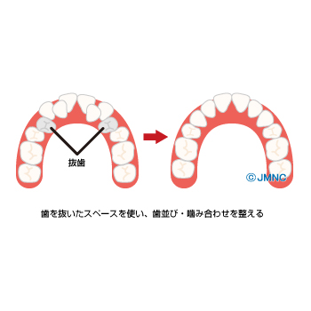 治療方法 装置の無料イラスト素材集 歯科 矯正歯科医院向け 矯正歯科ネット