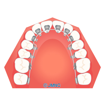 治療方法 装置の無料イラスト素材集 歯科 矯正歯科医院向け 矯正歯科ネット