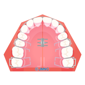 治療方法 装置の無料イラスト素材集 歯科 矯正歯科医院向け 矯正歯科ネット