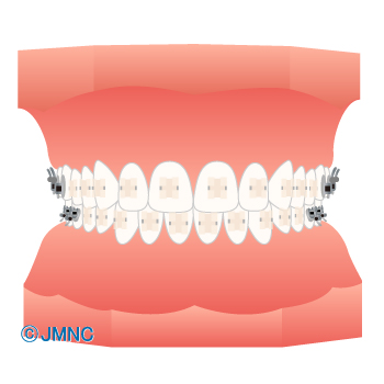 治療方法 装置の無料イラスト素材集 歯科 矯正歯科医院向け 矯正歯科ネット