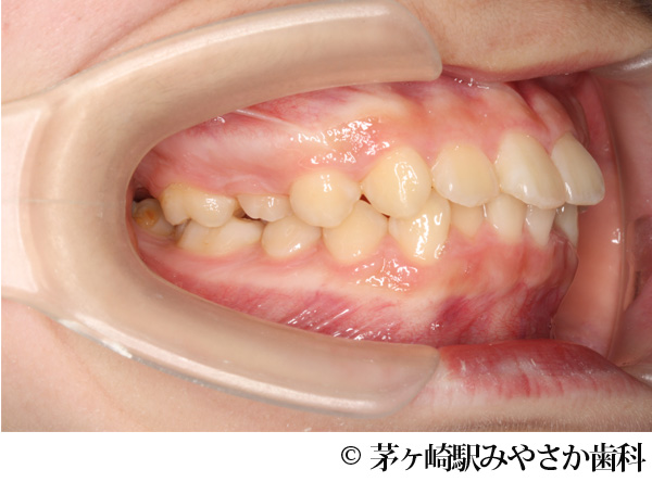 治療前